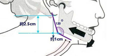 下頜角手術(shù)角度設(shè)計(jì)圖