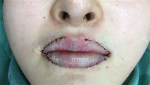 唇部缩小整形手术细节图.jpg