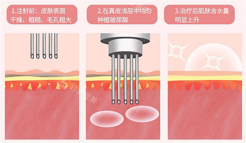 想了解韩国皮肤管理项目有哪些？我去做的LDM水滴提升太香了！大家一定要试试