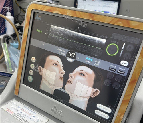美版超声提升效果更好吗？是的 我在韩国做超声提升医院全部推荐美版超声提升！