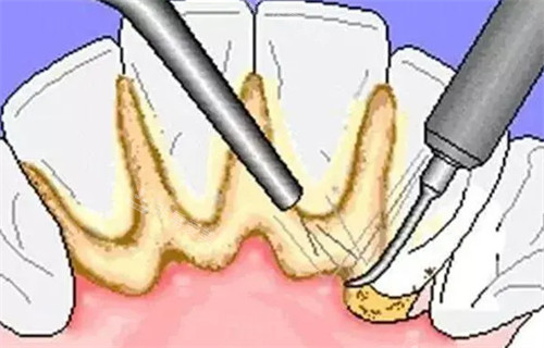 牙科洗牙去牙垢过程图片