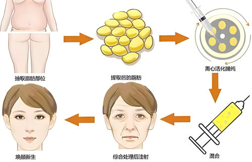 惊！自体脂肪填充卧蚕优势原来有这些！和玻尿酸填充卧蚕哪个更好呢？