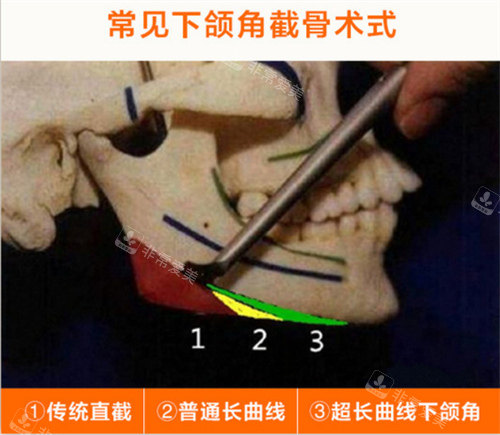 不同下頜角術(shù)式展示 不同下頜角術(shù)式展示