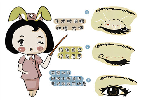 埋線優(yōu)點(diǎn)