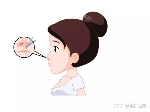 隆鼻縫合圖