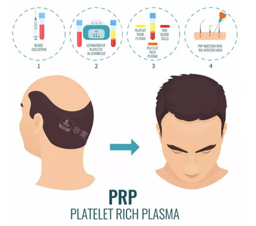 脱发PRP注射治疗前后对比图