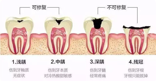 龋齿的几种情况