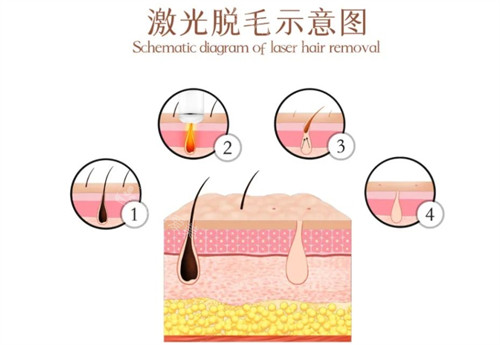 激光脱毛示意图