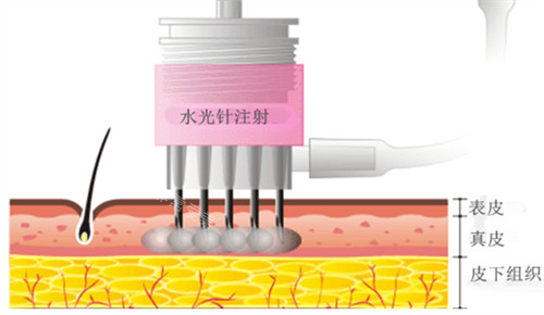 水光注射改善皮肤问题