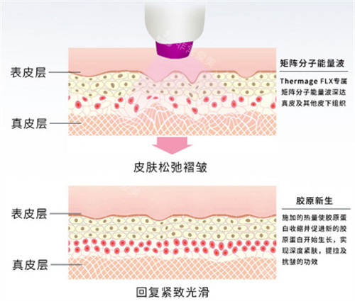 韩国做热玛吉哪家好一些?VS Line皮肤科与alive皮肤科的热玛吉项目都仪器正规有实惠!