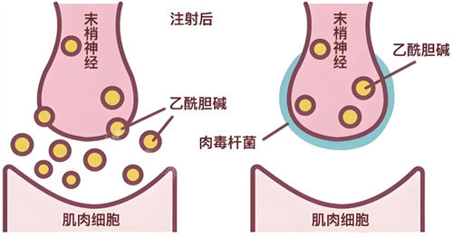 注射縮小鼻頭原理