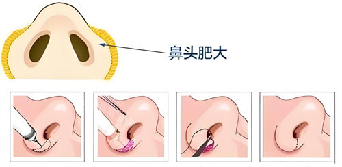 手術縮小鼻頭