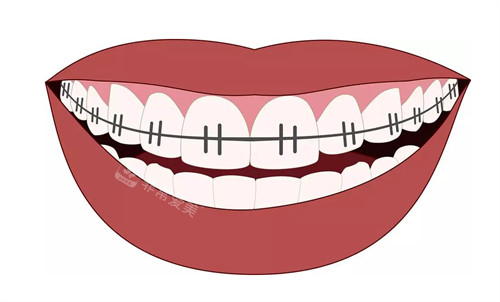 牙齿矫正矫正牙不齐