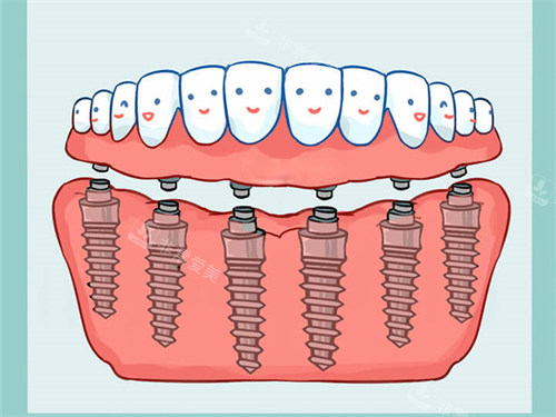 All-On-6全口种植牙漫画图