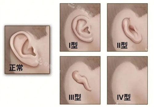 耳畸形的种类