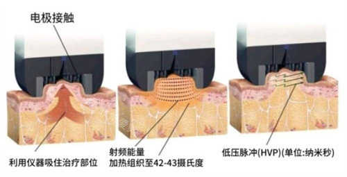 韩国inmode美容是什么项目?在韩国做过十次Inmode的我来告诉你!