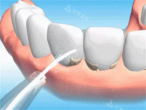 牙科洗牙过程图解
