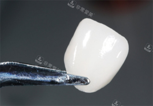 牙齒貼面的樣子圖片 牙齒貼面的樣子圖片