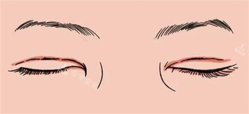 韩国哪个医生做双眼皮修复好？韩国双眼皮修复医生推荐！技术与口碑都很在线