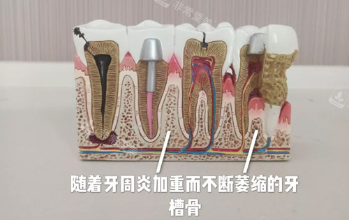 牙周炎对牙槽骨的影响