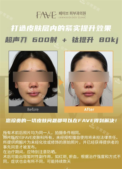 韩国fave皮肤科仪器抗衰前后对比图