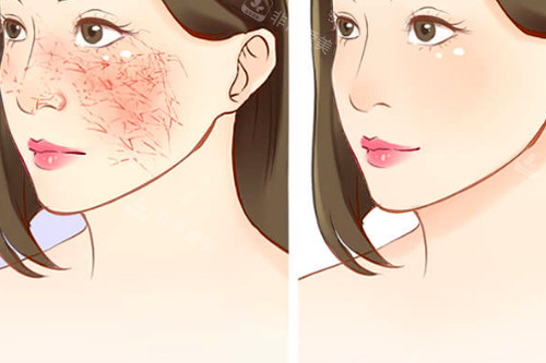 韩国去疤痕真实图片对比告诉你韩国露潭韩医院疤痕修复技术到底有多好!