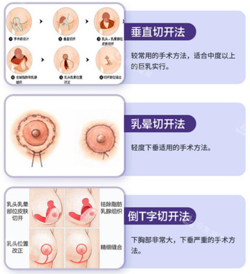 巨乳缩小手术过程