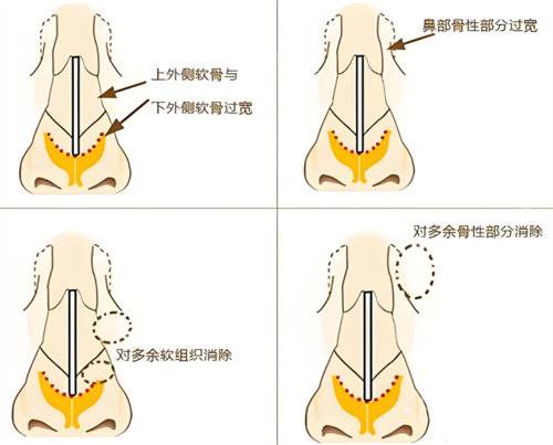 宽鼻矫正鼻骨原理