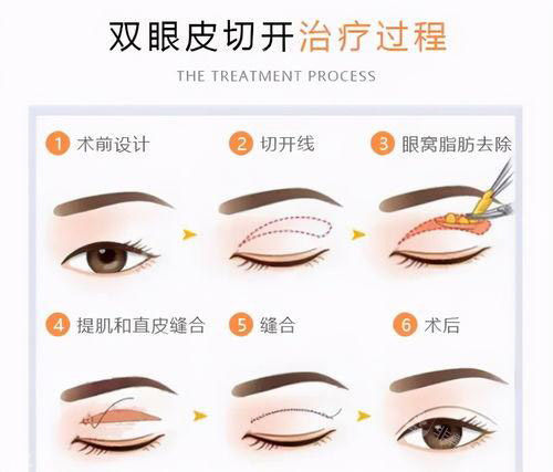 双眼皮手术方法过程图
