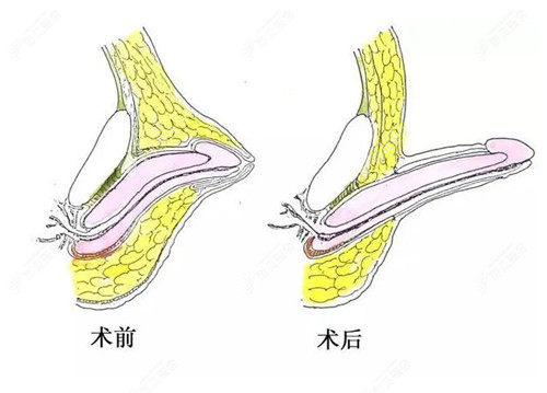 男性私密整形陰莖增長手術(shù)示意圖