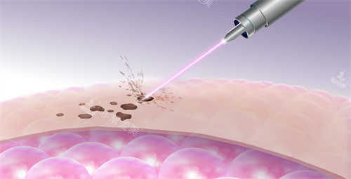 激光改善皮肤斑点