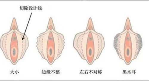 韓國私密整形可以恢復如初嗎，用我的親身經(jīng)歷告訴你！