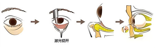 激光祛眼袋过程