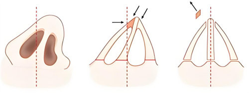 歪鼻矫正术图示