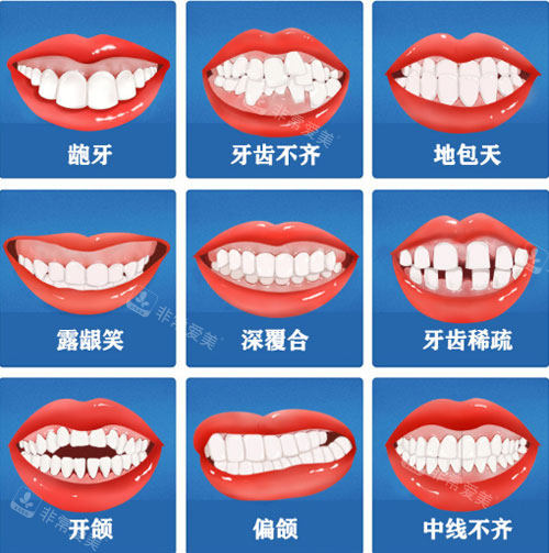 牙齿矫正适应症