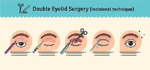 双眼皮修复手术过程
