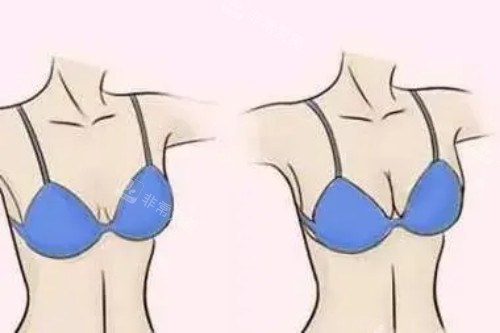 韓國水滴整形外科李英大醫(yī)生隆胸怎么樣?縮胸丨乳房再造丨女乳癥都是李院的拿手項目~