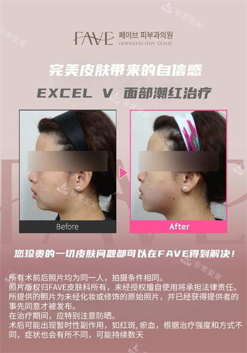 fave皮膚科醫(yī)院對比 fave皮膚科醫(yī)院對比