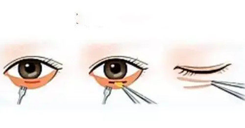 内切法祛眼袋简易步骤示意图