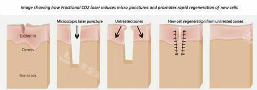 皮肤疤痕改善过程