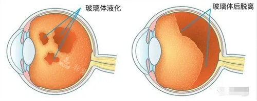 玻璃体问题图片