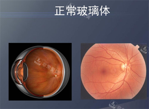 正常玻璃體圖片 正常玻璃體圖片