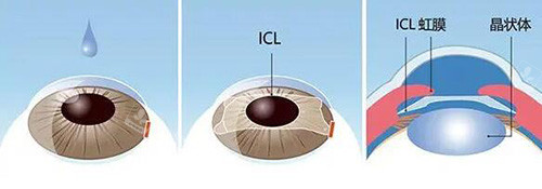 晶体植入改善展示图