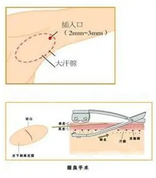 腋臭手術(shù)過程圖解