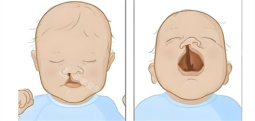 單側鼻畸形兔唇兒