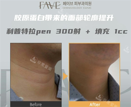 韓國(guó)Fave利普特拉pen300射+填充1CC前后對(duì)比 韓國(guó)Fave利普特拉pen300射+填充1CC前后對(duì)比