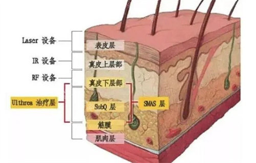 脂肪刀原理