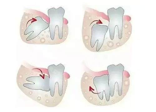 智齿的类型