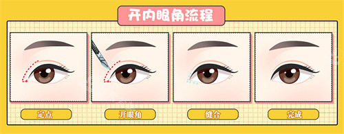 開(kāi)內(nèi)眼角手術(shù)過(guò)程