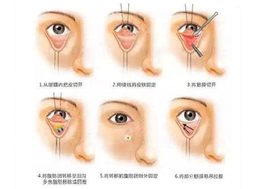 內(nèi)切去眼袋手術(shù)過(guò)程